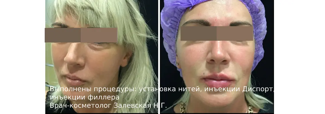 Фото до и после процедуры инъекции ботокса 7