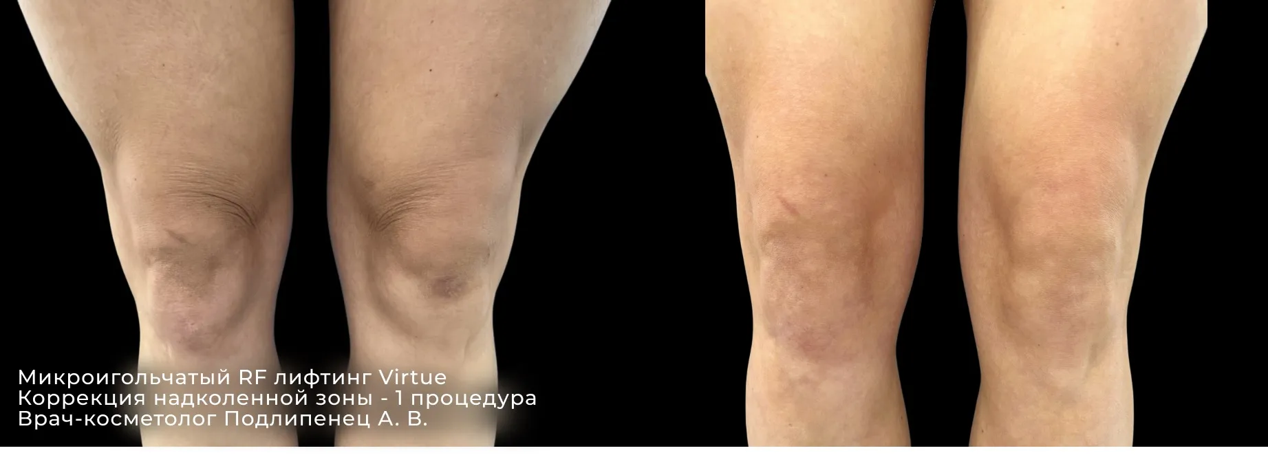 Фото до и после процедуры РФ-лифтинга рук 3