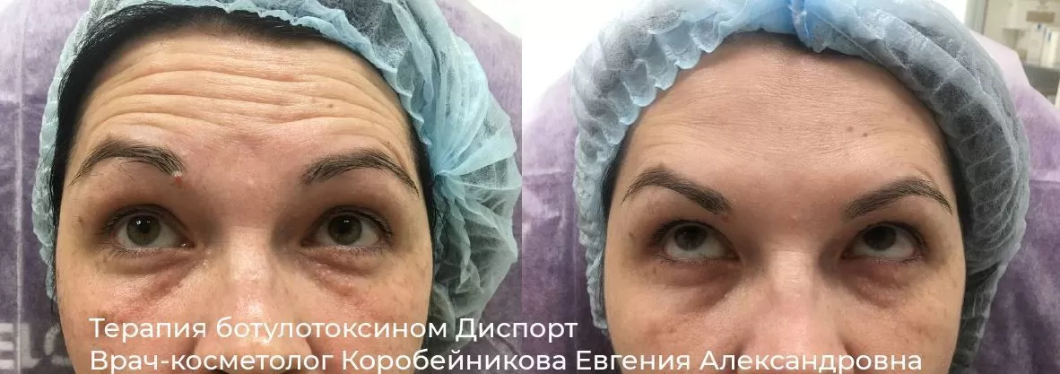 Фото результата инъекции ботокса 13