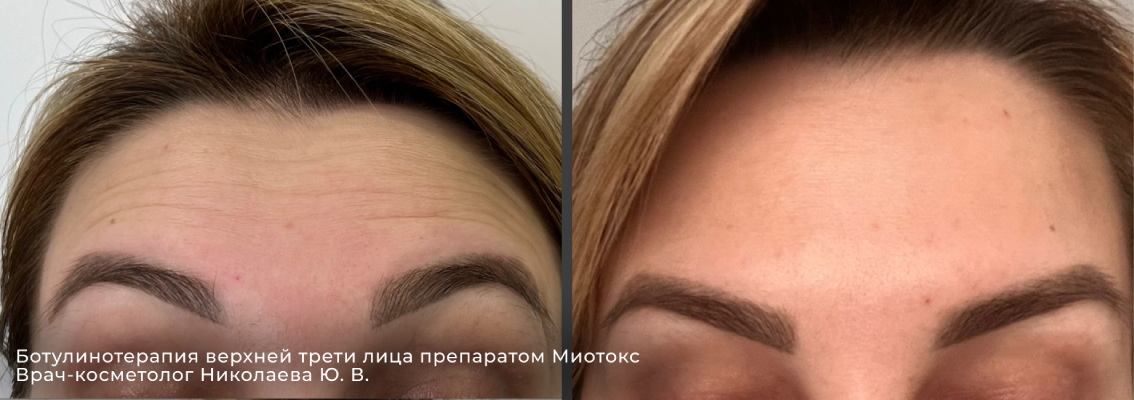 Фото до и после инъекции ботокса 14