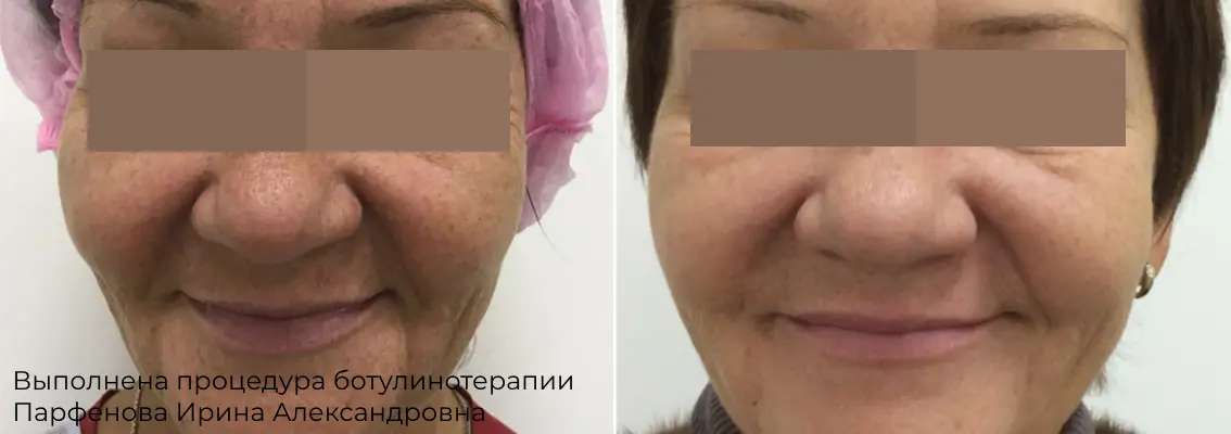 Фото до и после инъекции ботокса 12