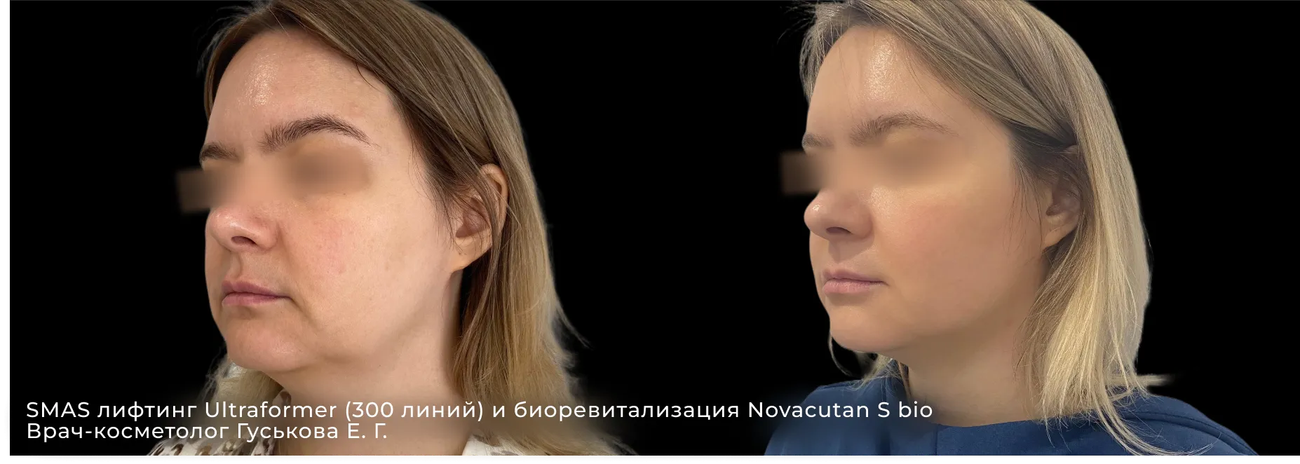 Фото до и после процедуры биоревитализации препаратом Реви (Revi) 3