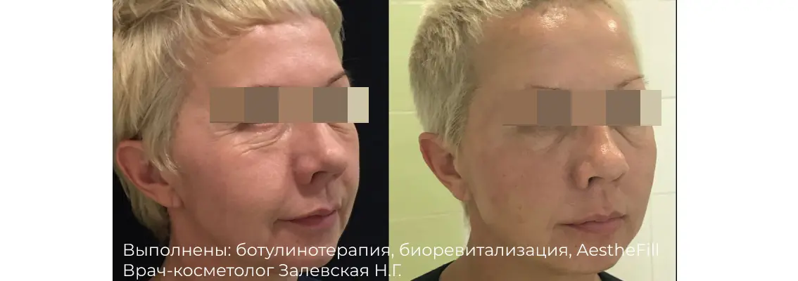 Фотографии после процедуры биоревитализации препаратом Реви (Revi) 2