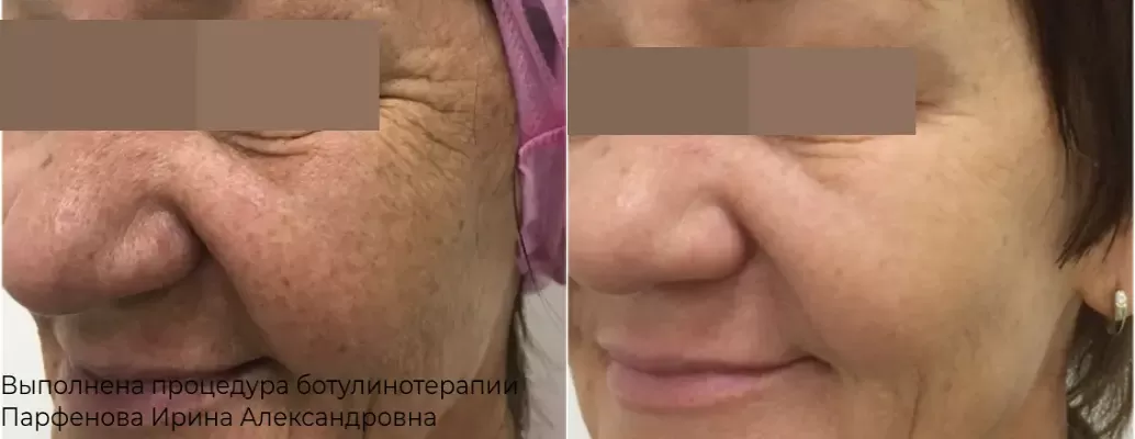 Фото до и после процедуры инъекции ботокса 11