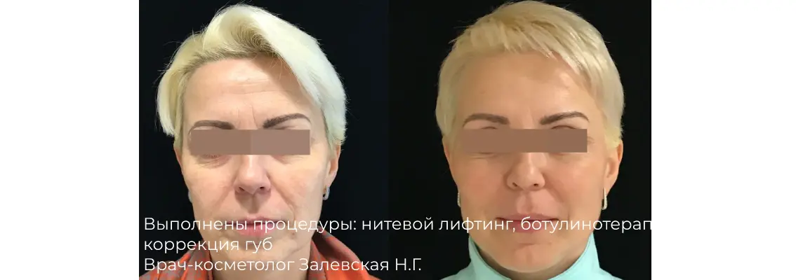 Фото результата инъекции ботокса 8